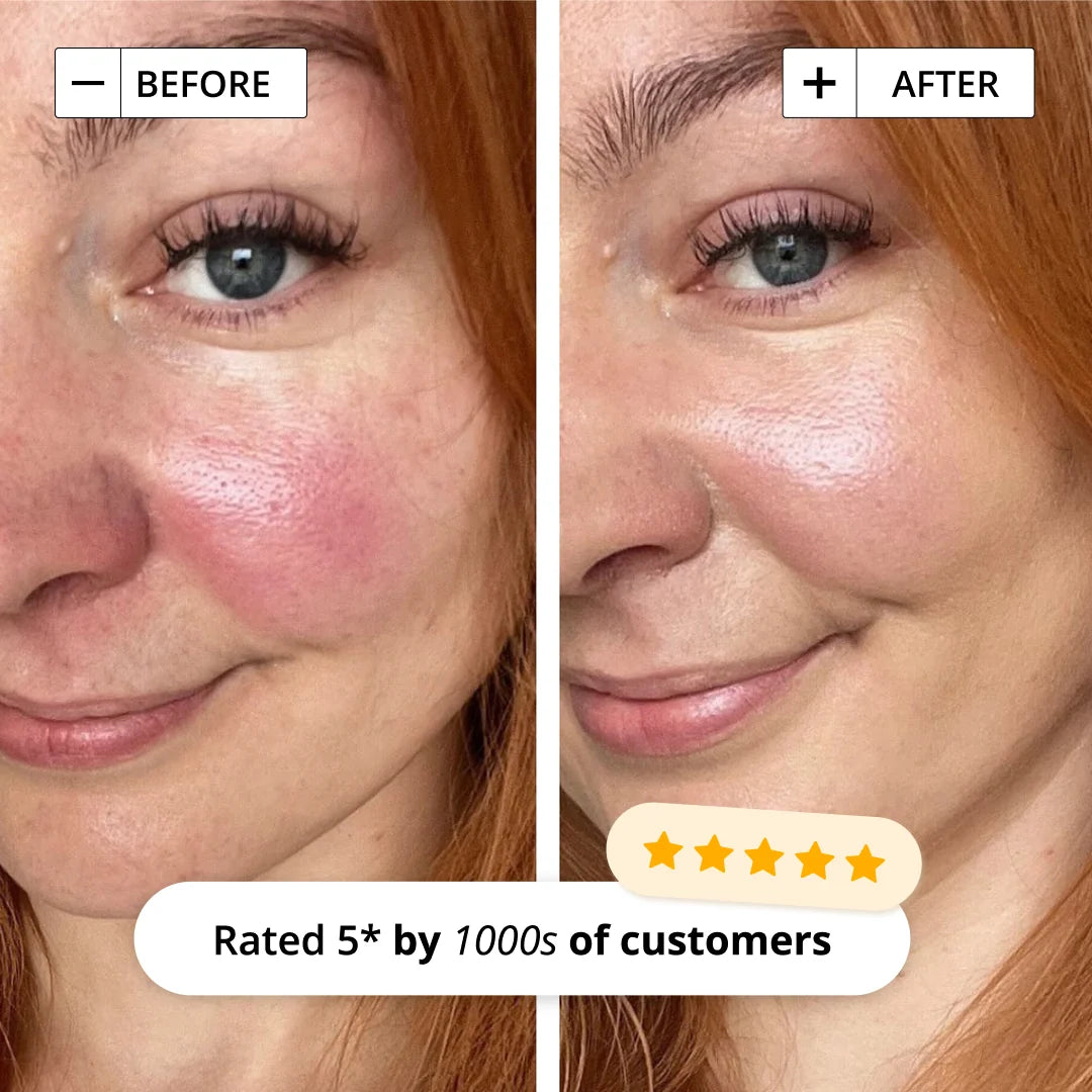 Sorted Skin Anti-Redness 5 in 1 Day Cream 30 ml